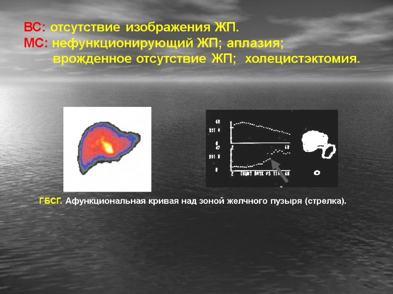 ВС: отсутствие изображения ЖП. МС: нефункционирующий ЖП; аплазия;      